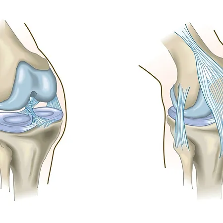 Ligament sprains and meniscus tears